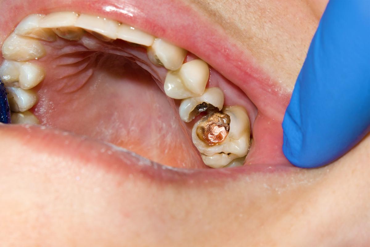 Dentiste endodontie